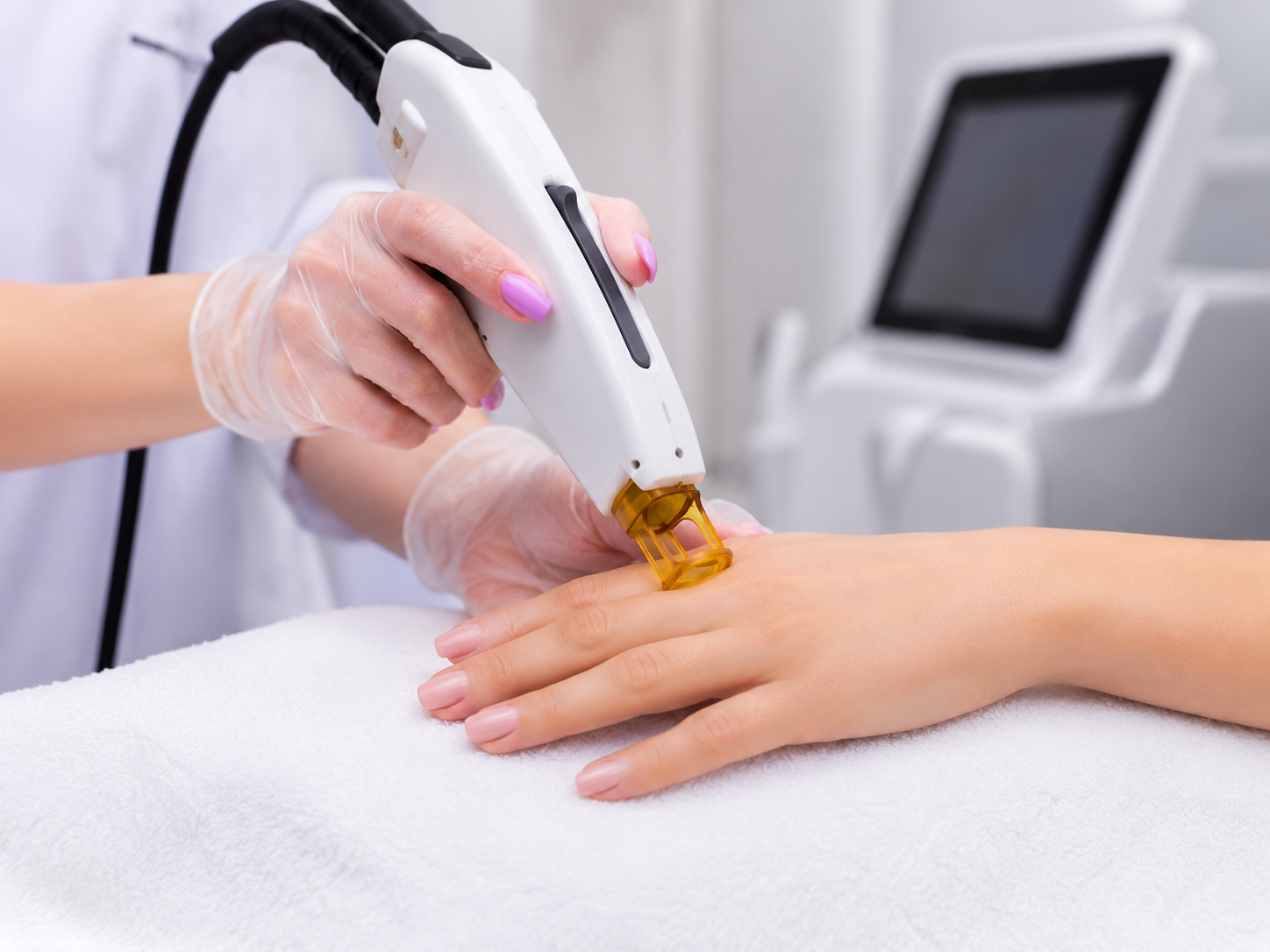 Prevención de pelos enquistados con depilación láser en LaserPro Valencia